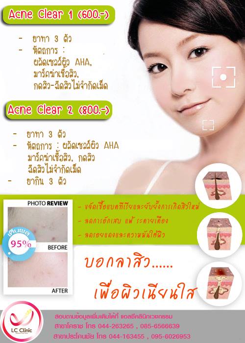 รักษา สิวทุกชนิด รอยสิว สิวที่หน้า สิวที่ตัวและหลัง ในโคราช & บุรีรัมย์