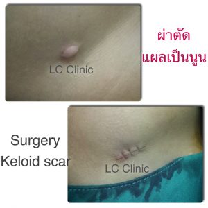 ผ่าตัดเล็ก ทำแผล กำจัดไฝ ขี้แมลงวัน กระเนื้อ ติ่งเนื้อ เย็บแผล ตัดไหม