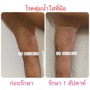 โรคตุ่มน้ำใสที่มือ ผิวหนังอักเสบ (Dyshidrosis) คืออะไร รักษายังไงดี