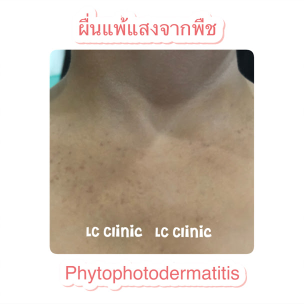 ผื่นแพ้แสงจากพืช รอยดำแพ้แสงจากพืช (Phytophotodermatitis) คืออะไร อาการ การรักษา