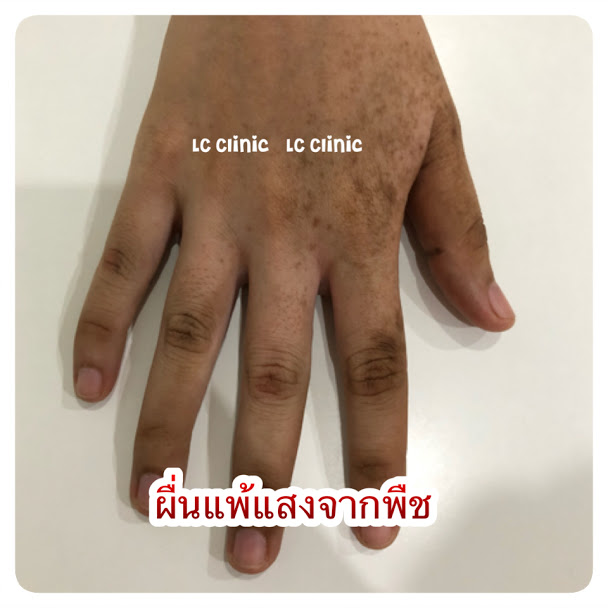 ผื่นแพ้แสงจากพืช รอยดำแพ้แสงจากพืช (Phytophotodermatitis) คืออะไร อาการ การรักษา