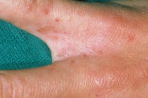 โรคหิด (Scabies) คืออะไร สาเหตุ อาการ การรักษา