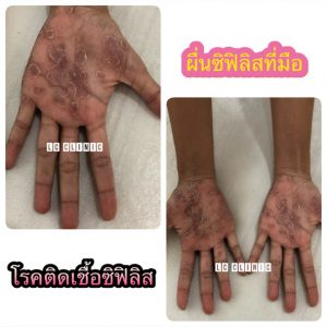 โรคซิฟิลิสที่ผิวหนัง (Syphilis) คืออะไร สาเหตุ อาการ รักษาโรคซิฟิลิส