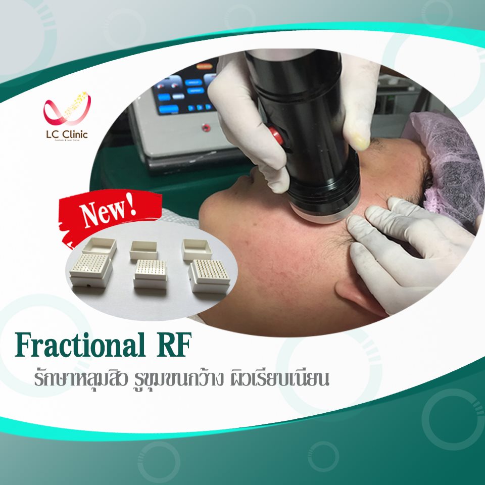 รักษาหลุมสิว ด้วยเครื่อง FRM (Fractional RF Microneedle)