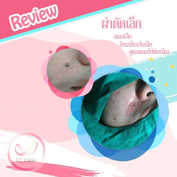 ผ่าตัดไฝ (Nevus) ทำยังไง ขั้นตอนการผ่าตัด การดูแลแผล