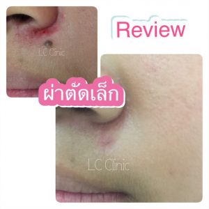 ผ่าตัดไฝ (Nevus) ทำยังไง ขั้นตอนการผ่าตัด การดูแลแผล