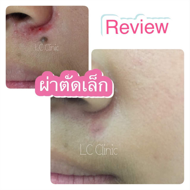 ผ่าตัดไฝ (Nevus) ทำยังไง ขั้นตอนการผ่าตัด การดูแลแผล