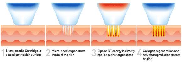 รักษาหลุมสิว ด้วยเครื่อง FRM (Fractional RF Microneedle)