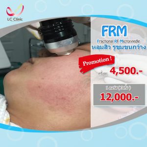 รักษาหลุมสิว ด้วยเครื่อง FRM (Fractional RF Microneedle)