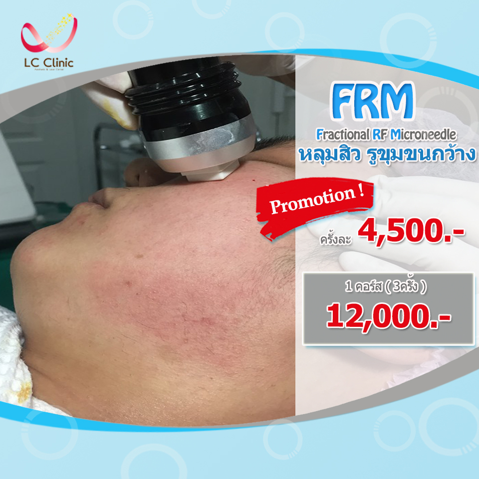 รักษาหลุมสิว ที่แอลซีคลินิก โคราช บุรีรัมย์ ดียังไง ?