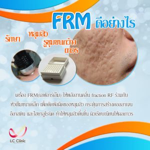 รักษาหลุมสิว ด้วยเครื่อง FRM (Fractional RF Microneedle)
