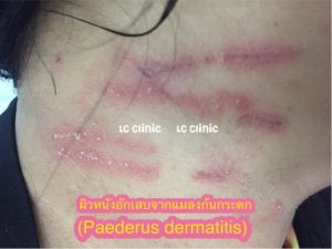 ผิวหนังอักเสบจากแมลงก้นกระดก (Paederus dermatitis) ผื่นจากแมลงกัด ตุ่มแพ้แมลงกัด คืออะไร สาเหตุ อาการ การรักษา