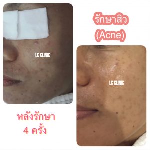 ข้อควรรู้เกี่ยวกับสิว ข้อควรรู้ในการดูแลตัวเองเมื่อเป็น... สิว