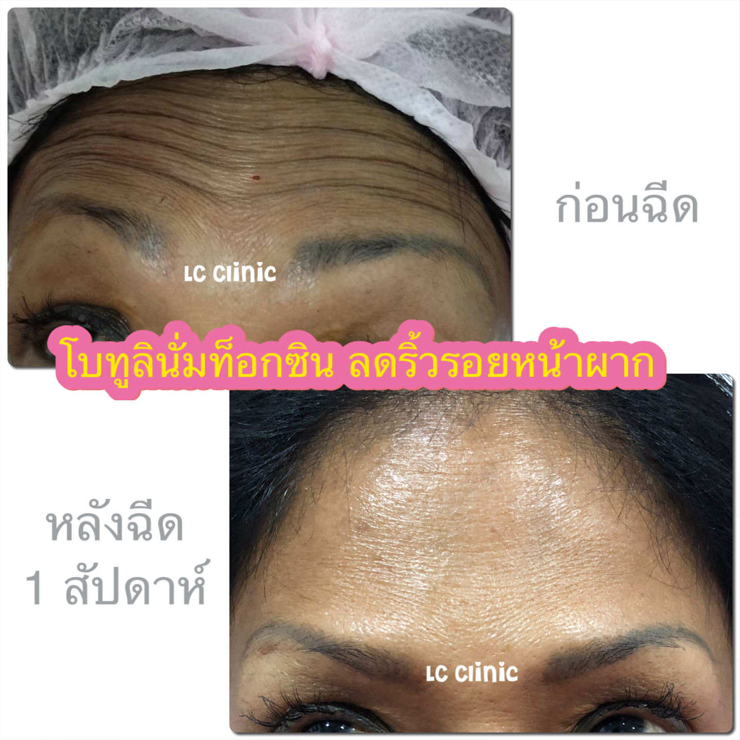 โบท็อกซ์ (Botulinum toxin) คืออะไร ช่วยลดริ้วรอย หน้าเรียว จริงไหม