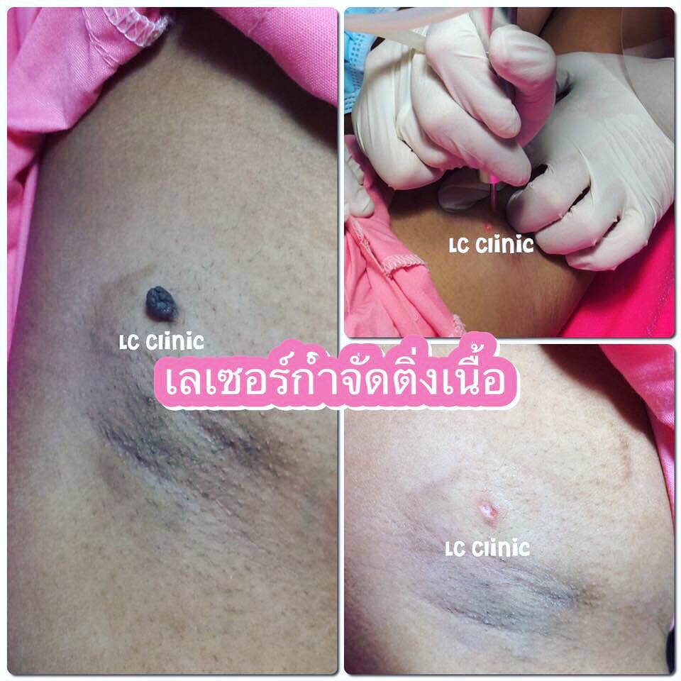 คลินิก กำจัดไฝ หูด กระเนื้อ ติ่งเนื้อ ต่อมไขมัน ยอดนิยม โคราช บุรีรัมย์