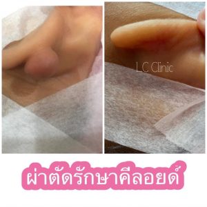 รีวิวการผ่าตัด รักษาแผลเป็นนูน แผลเป็นคีลอยด์ (Keloid)