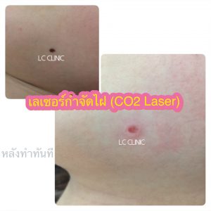 ผ่าตัดไฝ (Nevus) ทำยังไง ขั้นตอนการผ่าตัด การดูแลแผล