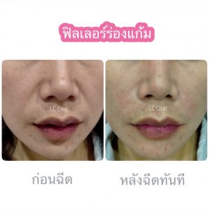 ฟิลเลอร์ร่องแก้ม ฉีดฟิลเลอร์ ร่องแก้ม คาง ใต้ตา แก้มตอบ แก้มส้ม โคราช บุรีรัมย์