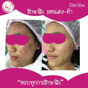 สิว จากแพ้เครื่องสำอาง (Acne Cosmetica) สิวพบบ่อยในผู้ใหญ่ คืออะไร รักษายังไง