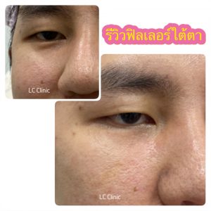 ฟิลเลอร์ (Filler) คืออะไร ฉีดฟิลเลอร์ ร่องแก้ม คาง ใต้ตา แก้มตอบ แก้มส้ม โคราช บุรีรัมย์