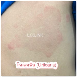 โรคลมพิษเรื้อรัง Chronic urticaria คืออะไร อาการ สาเหตุ การรักษา