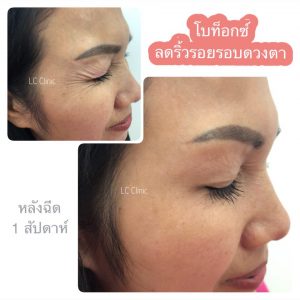 ฉีดโบท็อก ลดริ้วรอย หน้าผาก รอบดวงตา ลดกราม โคราช บุรีรัมย์