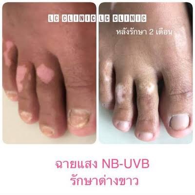 โรคด่างขาว (Vitiligo) คืออะไร สาเหตุ อาการ และการรักษา