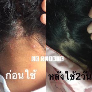 โรคเซบเดิร์ม (Seborrheic Dermatitis) ผิวหนังอักเสบ ที่ร่องจมูก และหนังศีรษะ