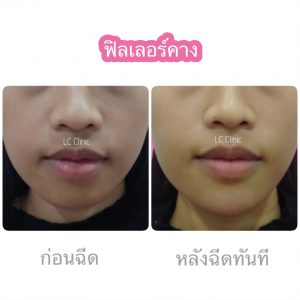 ฉีดฟิลเลอร์ ร่องแก้ม คาง ใต้ตา แก้มตอบ แก้มส้ม โคราช บุรีรัมย์