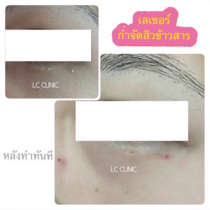 สิวข้าวสาร (Milia) การรักษาสิวข้าวสาร กดออก ยาทา เลเซอร์