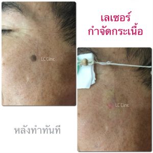 เลเซอร์กระเนื้อ (CO2 Laser) ทำยังไง การดูแลแผลหลังทำเลเซอร์