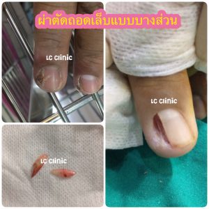 เล็บขบ Ingrown nail เกิดจากอะไร รักษายังไงดีน่า