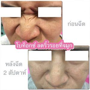 ฉีดโบท็อก ลดริ้วรอย บนใบหน้า หน้าผาก หางตา ขมวดคิ้ว ทำยังไง