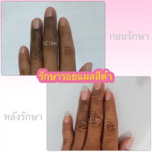 รอยแผลเป็น สีดำ คืออะไร รักษายังไง ยากิน ยาทา ทรีทเมนท์ เลเซอร์