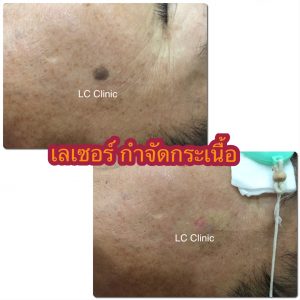 เลเซอร์กระเนื้อ (CO2 Laser) ทำยังไง การดูแลแผลหลังทำเลเซอร์