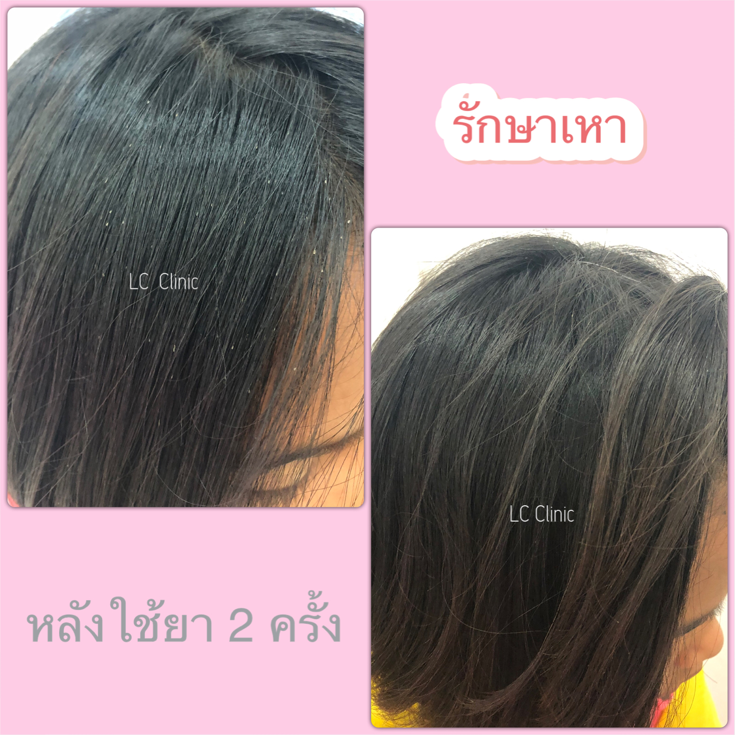 เหา ที่ศีรษะ เส้นผม (Louse) รักษาเหา กำจัดเหา ทำยังไง