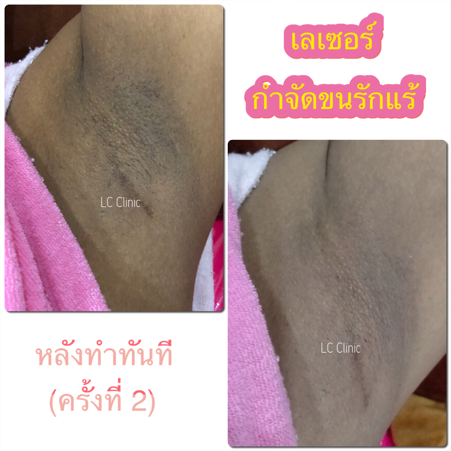 ไดโอดเลเซอร์ Diode laser กำจัดขนถาวร ช่วยให้ผิวเรียบเนียน