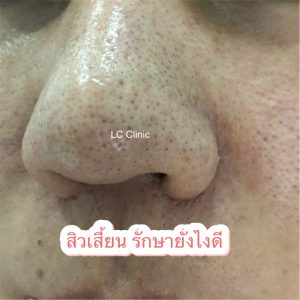 สิวเสี้ยน คืออะไร สาเหตุ อาการ การรักษา การป้องกัน