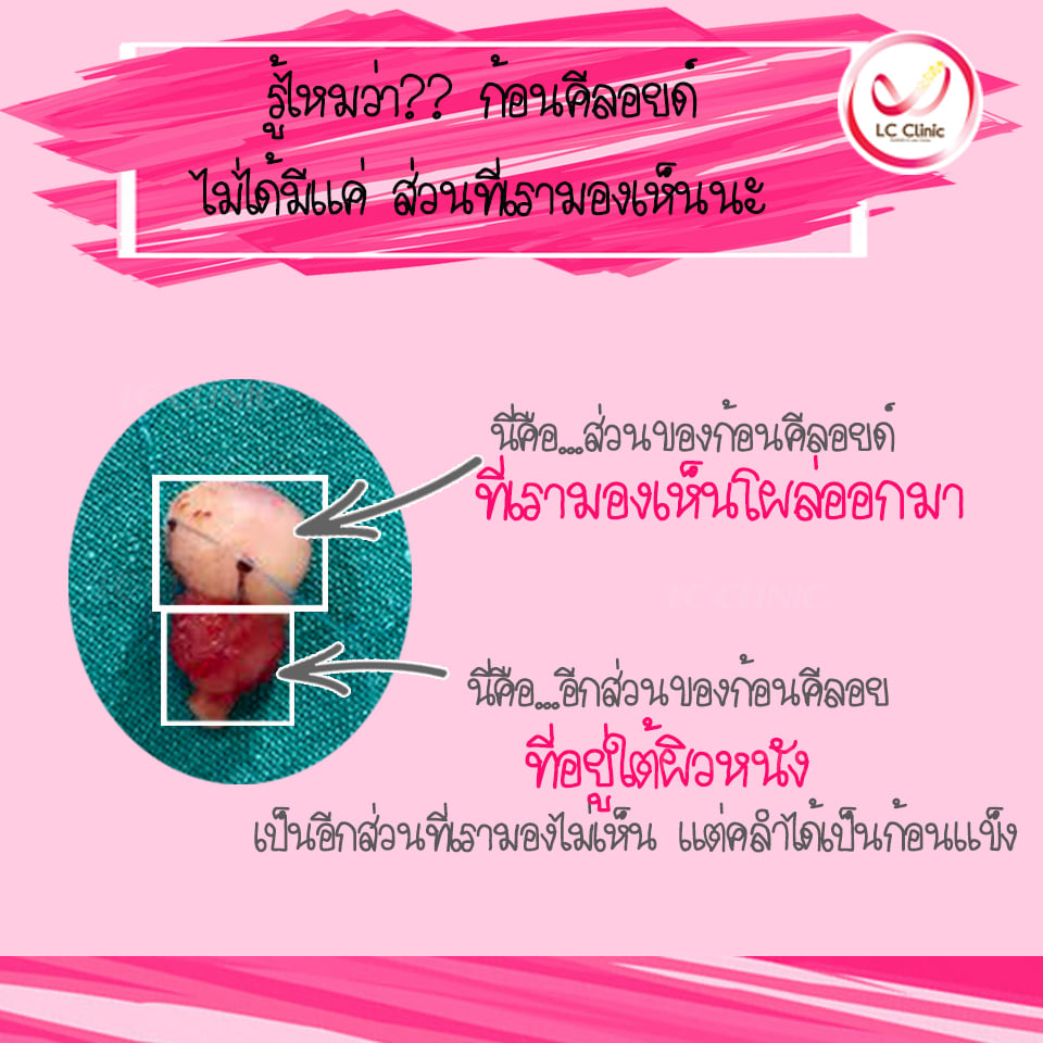 คีลอยด์ที่หู คืออะไร ผ่าตัด รักษา คีลอยด์ ที่หู ทำยังไง