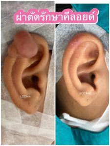 คีลอยด์ที่หู คืออะไร ผ่าตัด รักษา คีลอยด์ ที่หู ทำยังไง