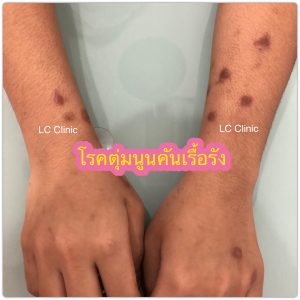 โรคตุ่มนูนคันเรื้อรัง (Prurigo nodularis) คืออะไร รักษายังไงดี