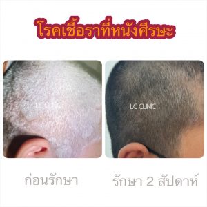 โรคกลาก เชื้อราบนหนังศีรษะ (Tinea Capitis) เชื้อราที่หนังศีรษะ เกิดจากอะไร รักษายังไงดี