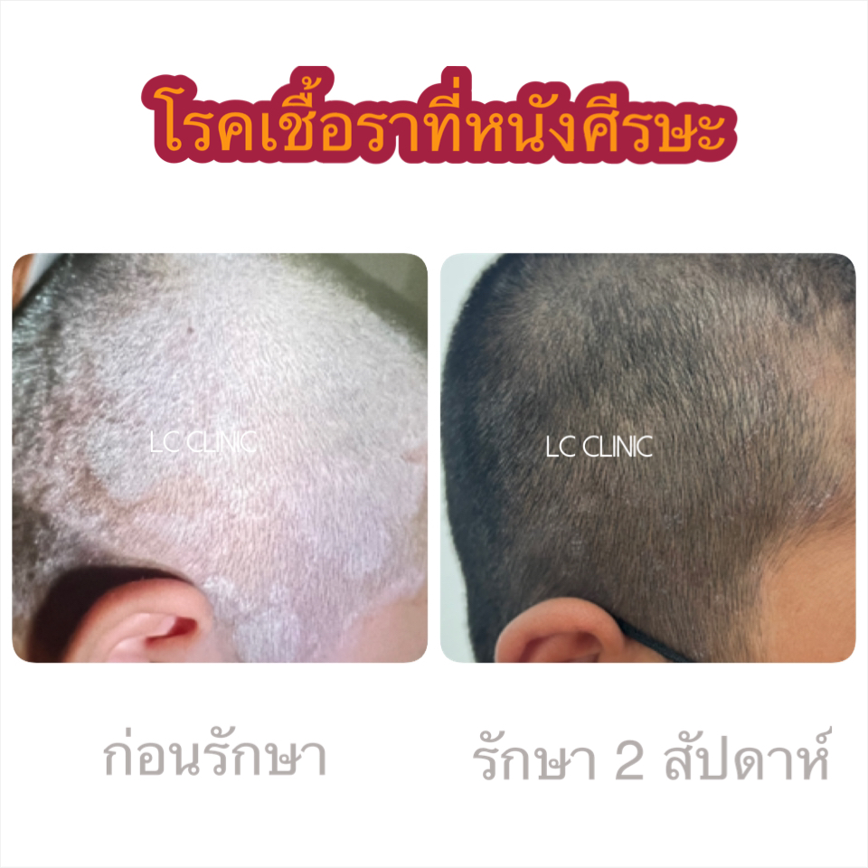 โรคกลาก เชื้อราบนหนังศีรษะ (Tinea Capitis) สาเหตุ อาการ และการรักษา