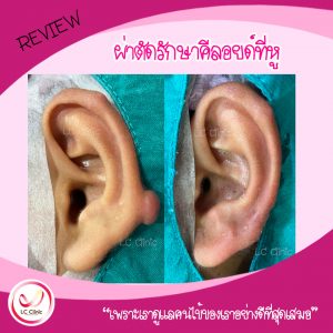 รีวิวการผ่าตัด รักษาแผลเป็นนูน แผลเป็นคีลอยด์ (Keloid)