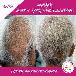 ผมร่วงเป็นหย่อม โรคผมร่วงเป็นหย่อม (Alopecia areata)