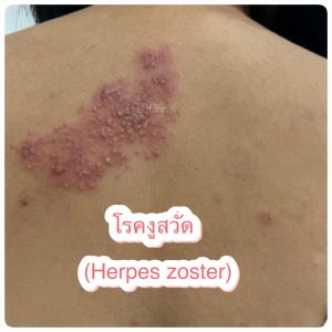 โรคงูสวัด (Herpes Zoster) เกิดจากอะไร อาการ และการรักษา