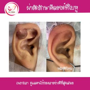 ผ่าตัดคีลอยด์ที่หู เลเซอร์ ฉีดยา รักษา แผลเป็น คีลอยด์ที่หู แผลเป็นนูน คีลอยด์ Keloid 