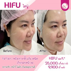 HIFU คืออะไร ช่วยยกกระชับ ทำให้ใบหน้าเรียว ได้อย่างไร โคราช บุรีรัมย์