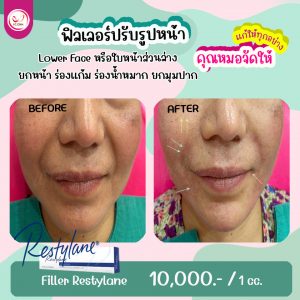 ฟิลเลอร์ Filler คืออะไร เติมเต็มร่องลึก ปรับรูปหน้าได้ อย่างไร