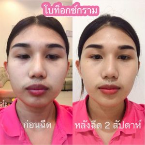 ฉีดโบท็อก ลดริ้วรอย หน้าผาก รอบดวงตา รอยขมวดคิ้ว รอยย่นจมูก ลดกราม โคราช บุรีรัมย์